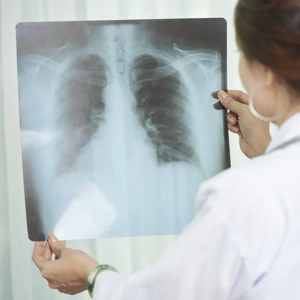 Lung X-ray image after quit smoking hypnosis X-ray showing lung health improvement after quit smoking hypnosis in Sydney